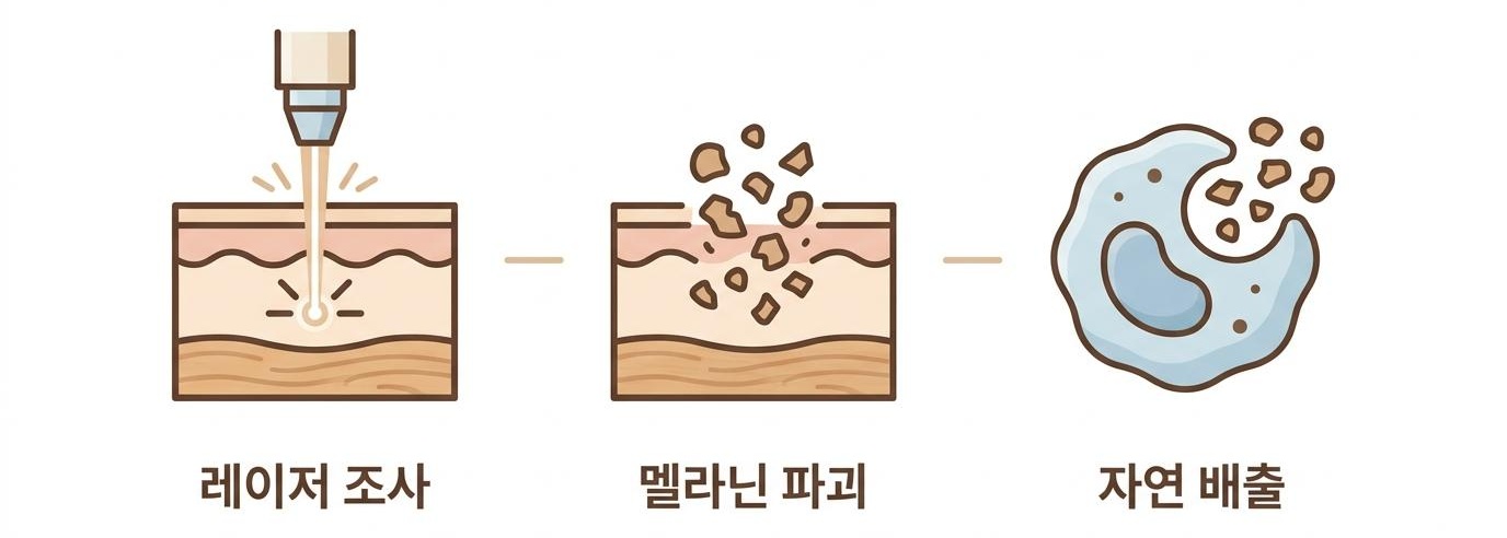 레이저가 멜라닌 색소를 미세하게 분쇄하는 과정, 북가좌동색소침착한의원 | 레이저 조사 · 멜라닌 파괴 · 자연 배출