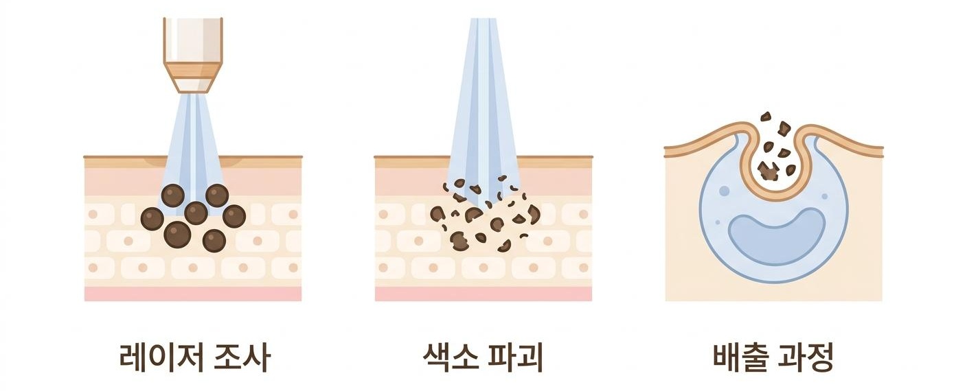 레이저가 멜라닌 색소를 미세하게 분쇄하고 배출하는 과정, 북가좌동기미치료한의원 | 레이저 조사 · 색소 파괴 · 배출 과정