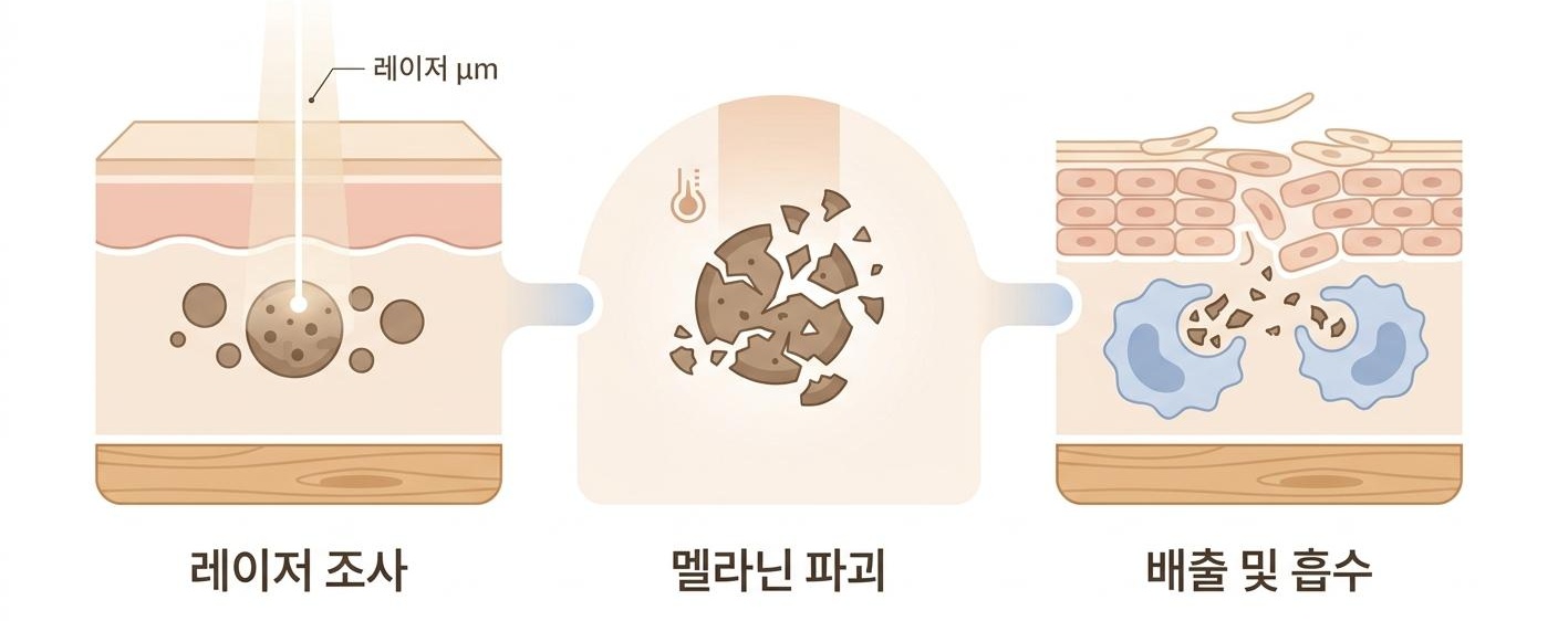 잡티 레이저토닝의 멜라닌 타겟팅 원리, 남가좌동레이저치료한의원 | 레이저 조사 · 멜라닌 파괴 · 배출 및 흡수