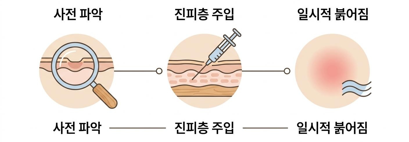 PDRN 스킨부스터의 시술 과정과 핵심 단계, 서대문구연어DNA클리닉 사전 파악 · 진피층 주입 · 일시적 붉어짐