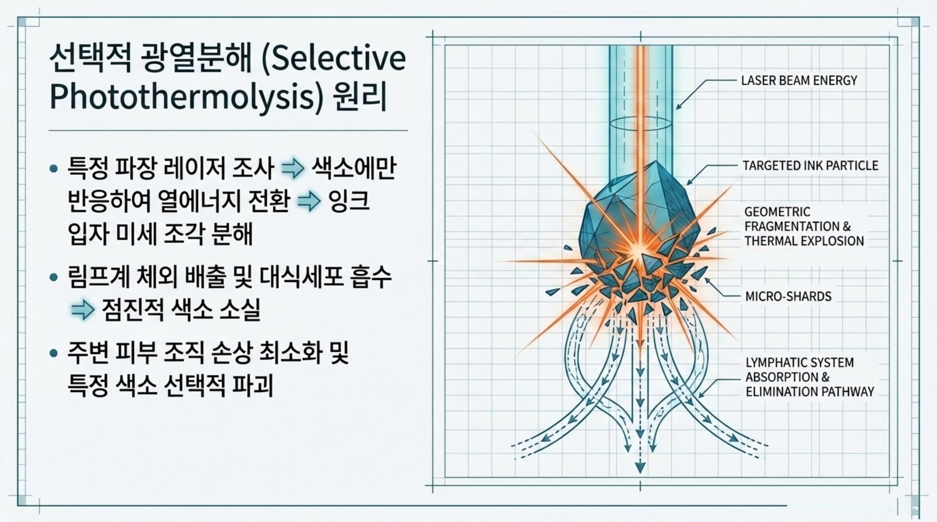 선택적 광열분해 (Selective Photothermolysis) 원리