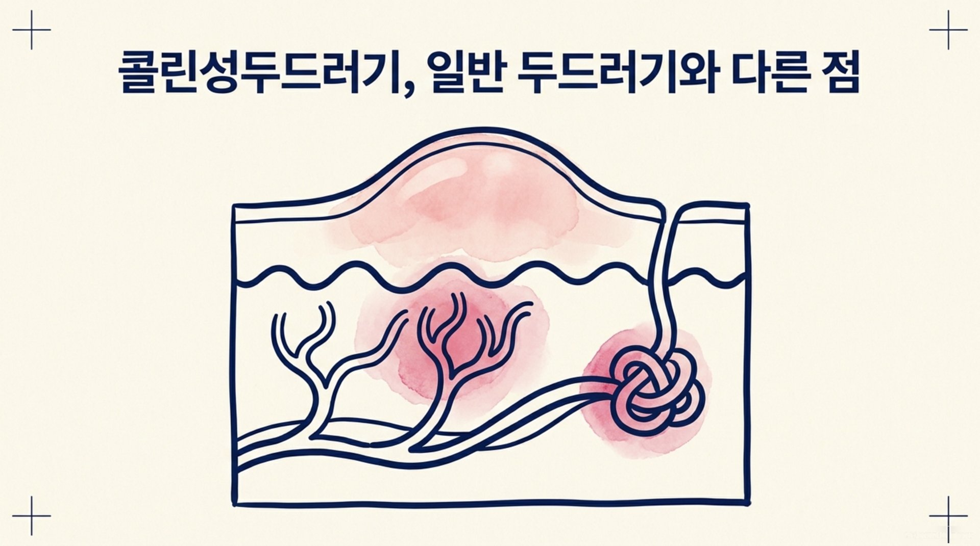 남가좌동 한의원 콜린성두드러기, 일반 두드러기와 다른 점 안내 이미지