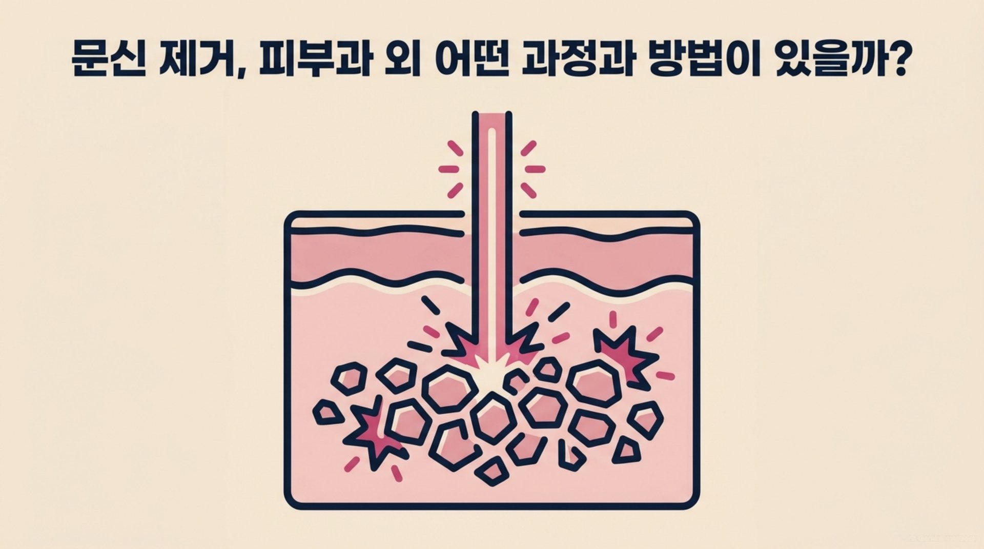 남가좌동 한의원 문신 제거, 피부과 외 어떤 과정과 방법이 있을까? 안내 이미지