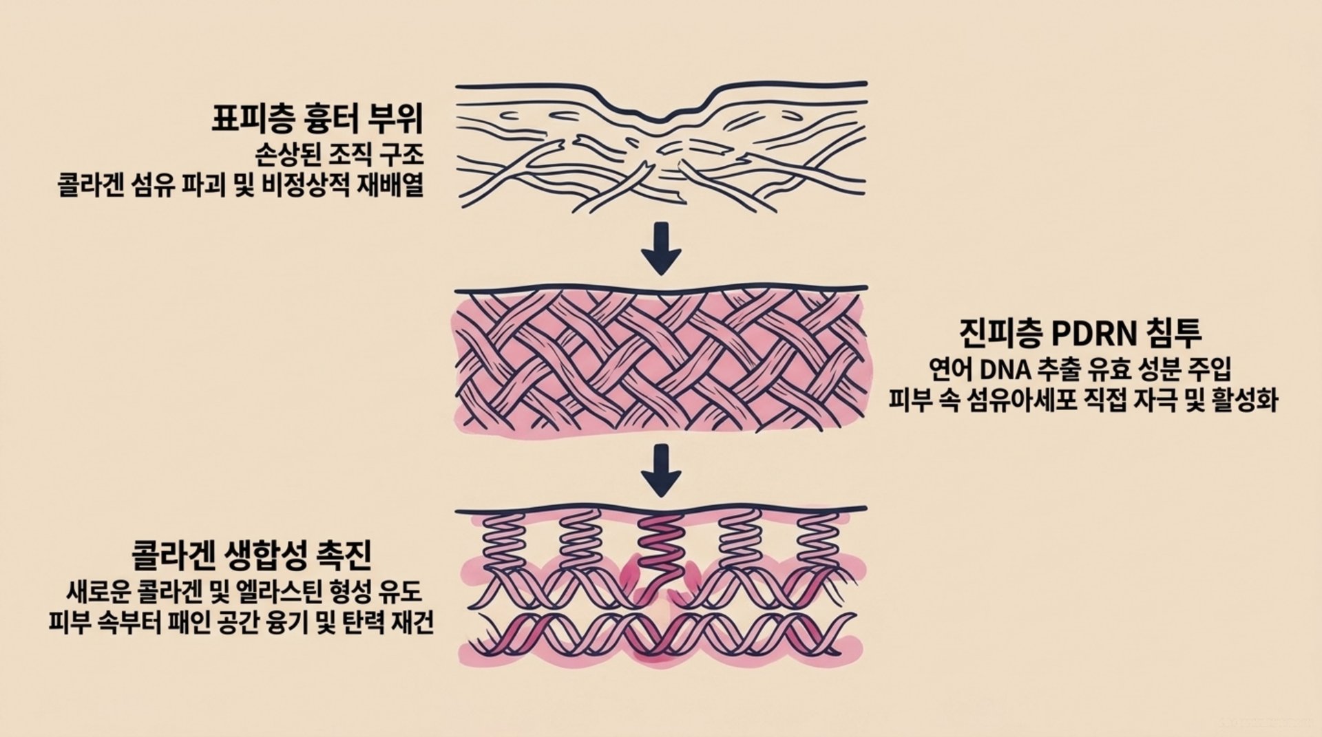 서대문구 한의원 스킨부스터의 피부 재생 원리 안내 이미지
