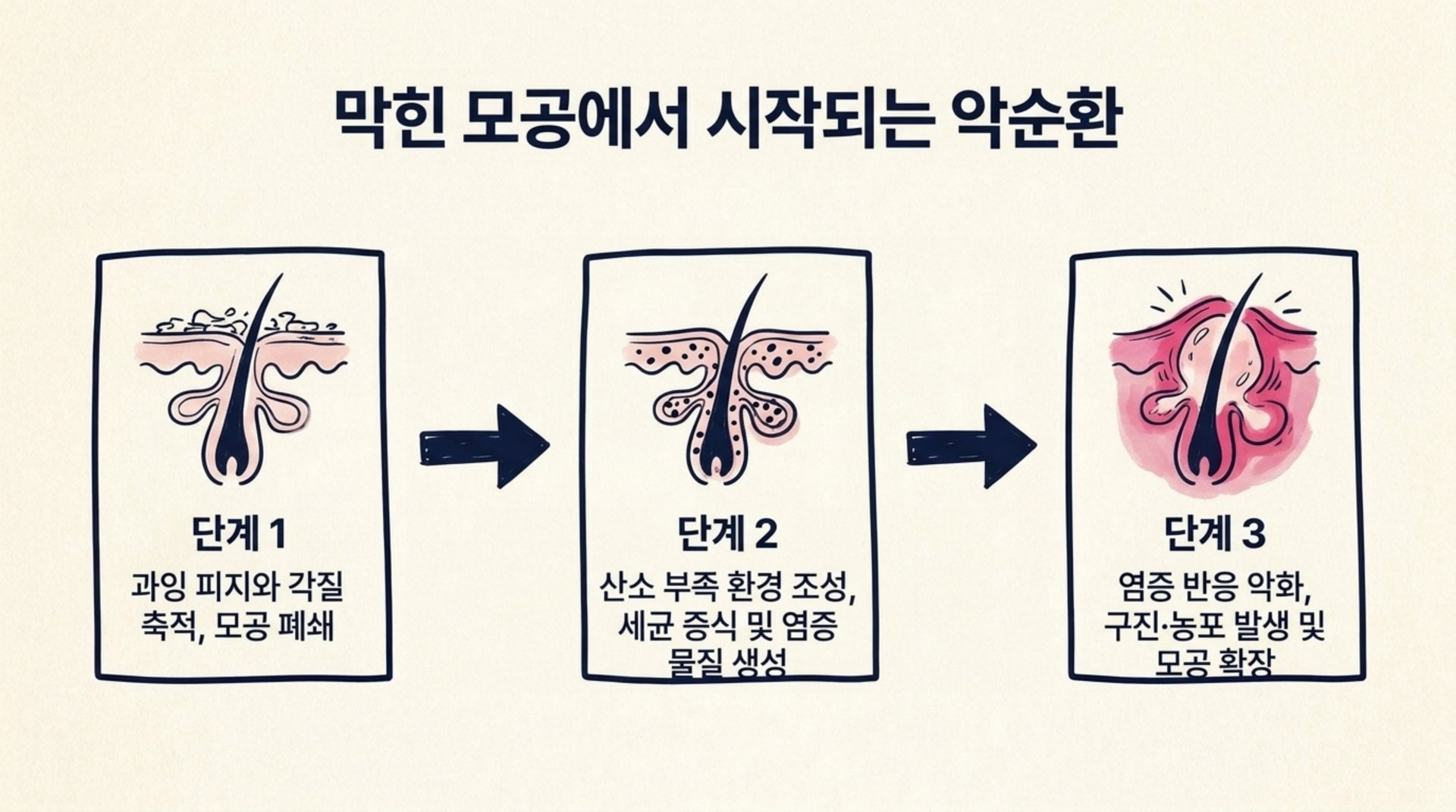 서대문구 한의원 막힌 모공에서 시작되는 악순환 안내 이미지