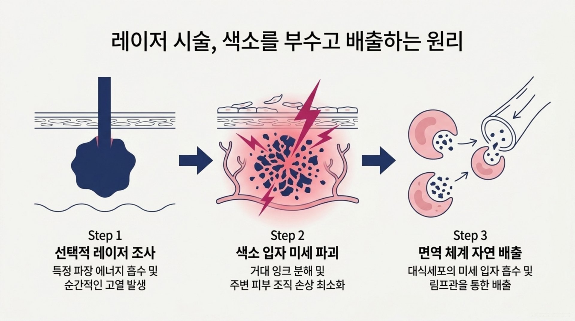 서대문구 한의원 레이저 시술, 색소를 부수고 배출하는 원리 안내 이미지