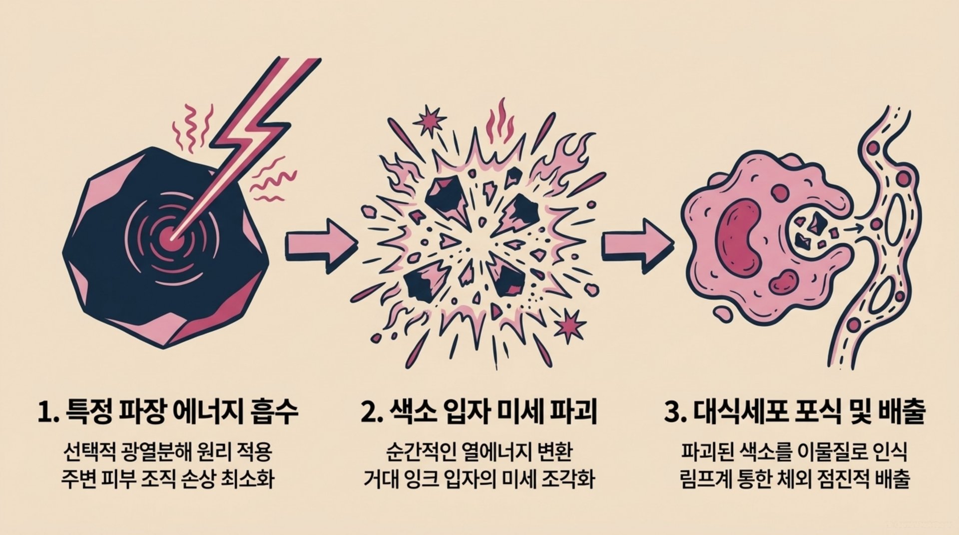 서대문구 한의원 선택적 광열분해 원리 안내 이미지