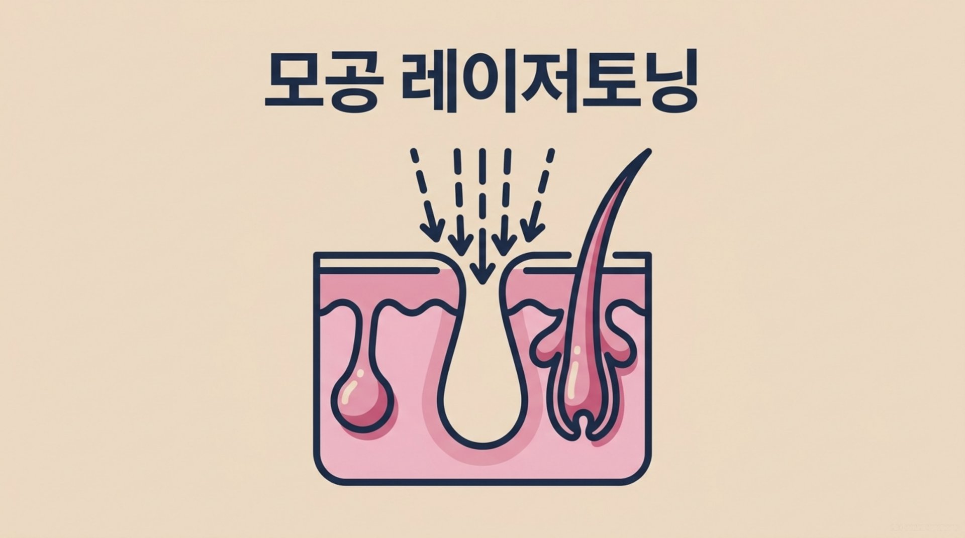 남가좌동 한의원 모공 레이저토닝 안내 이미지