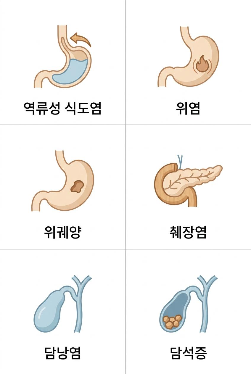 명치 답답함의 주요 소화기계 원인 6가지, 북가좌동명치답답치료한의원 역류성 식도염 · 위염 · 위궤양 · 췌장염 · 담낭염 · 담석증