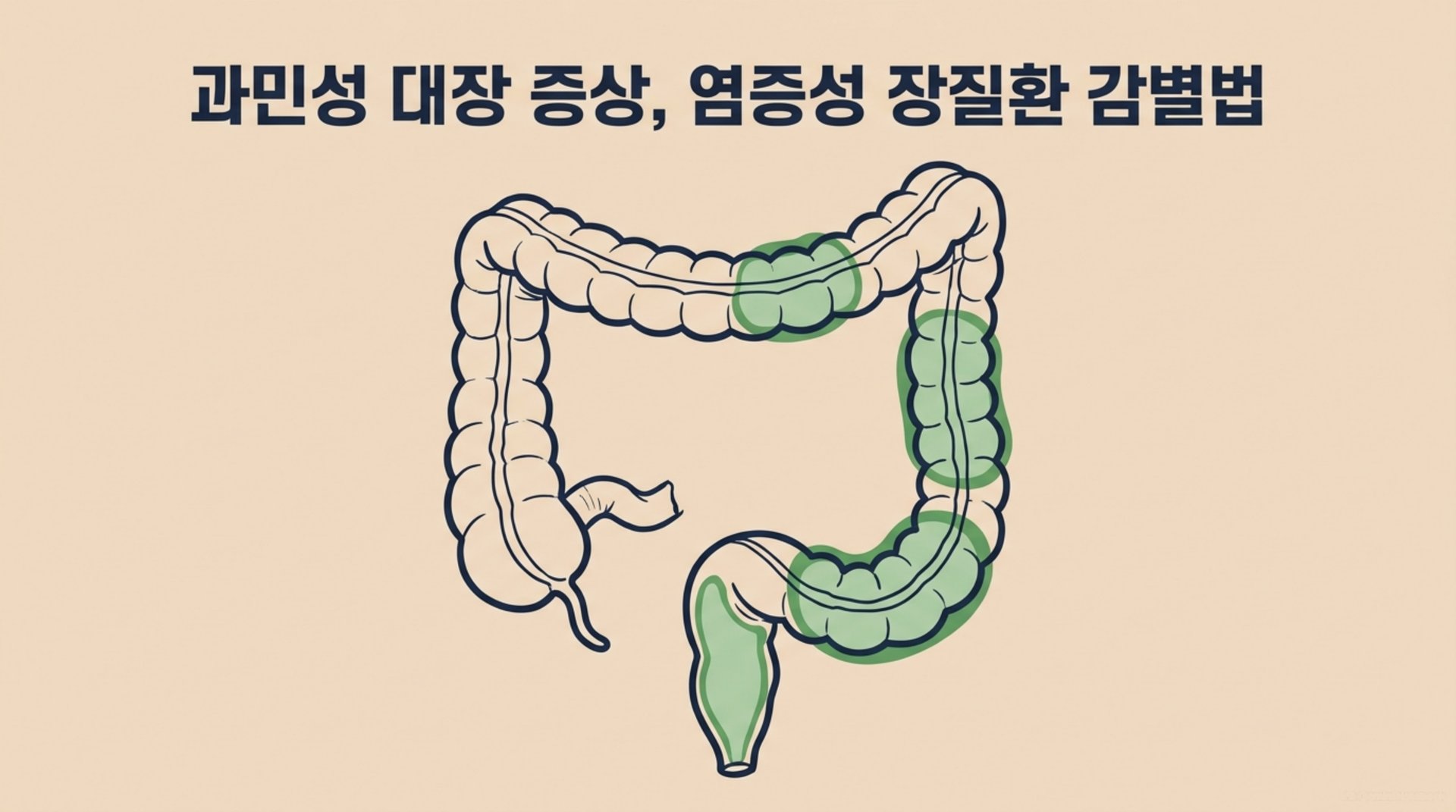 남가좌동 한의원 과민성 대장 증상, 염증성 장질환 감별법 안내 이미지