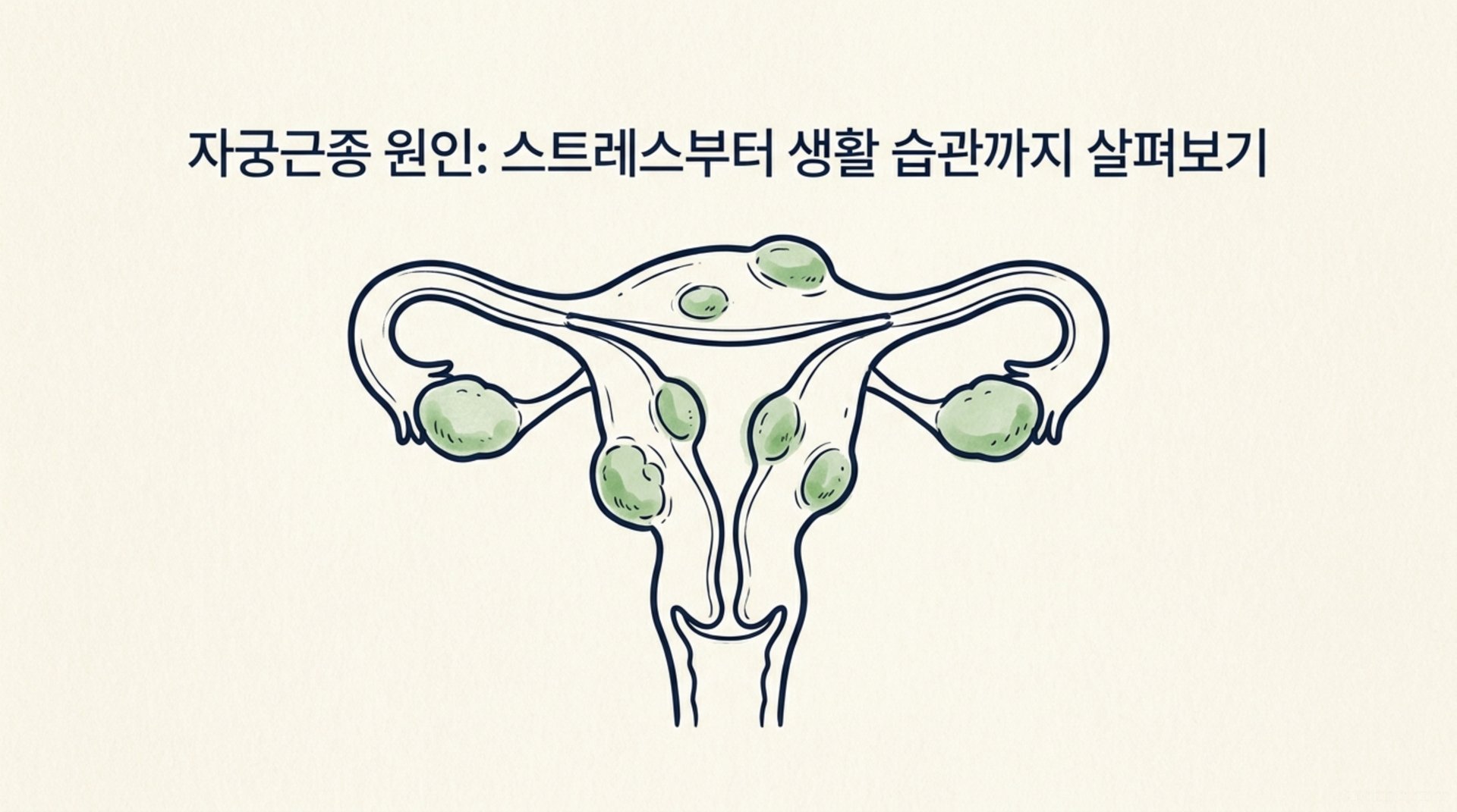 남가좌동 한의원 자궁근종 원인: 스트레스부터 생활 습관까지 살펴보기 안내 이미지
