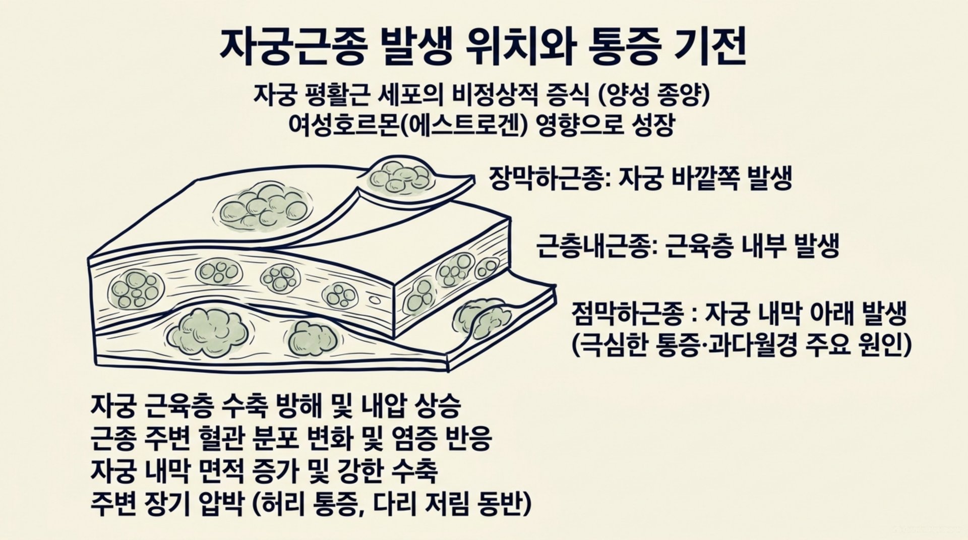 북가좌동 한의원 자궁근종 발생 위치와 통증 기전 안내 이미지