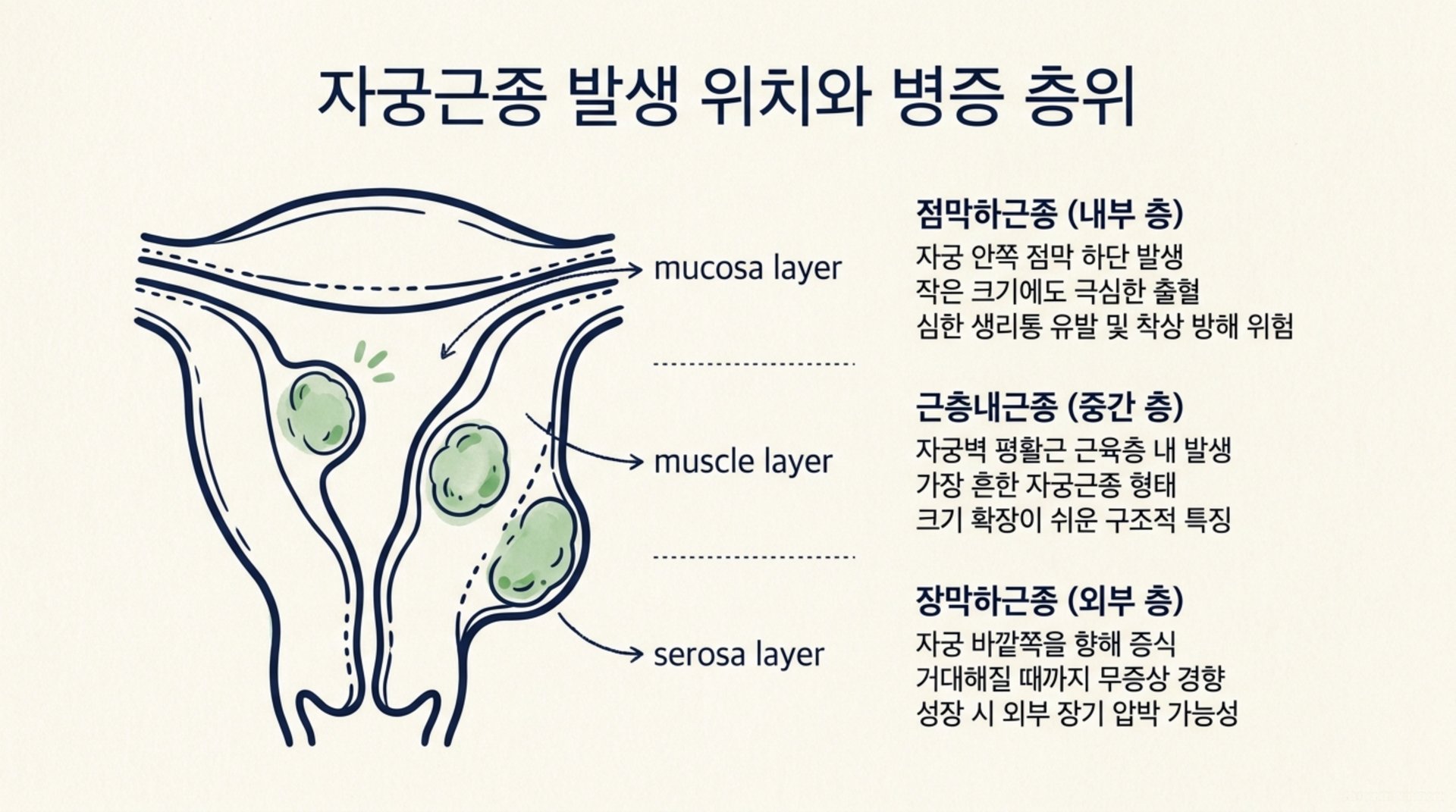 북가좌동 한의원 자궁근종 발생 위치와 병증 층위 안내 이미지