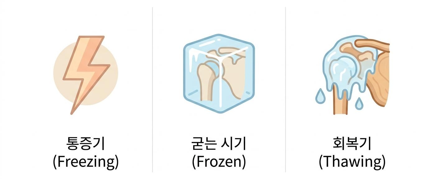 오십견의 3가지 진행 단계별 특징, 남가좌동유착성관절낭염한의원 | 통증기 (Freezing) · 굳는 시기 (Frozen) · 회복기 (Thawing)
