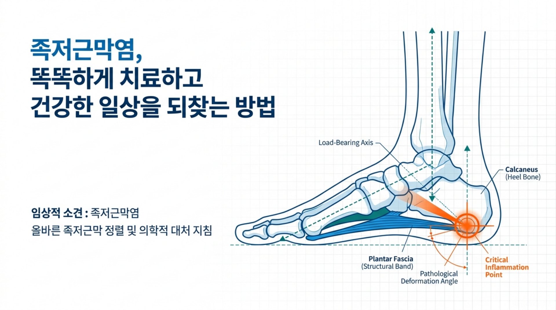 족저근막염의 정의와 병리적 변화