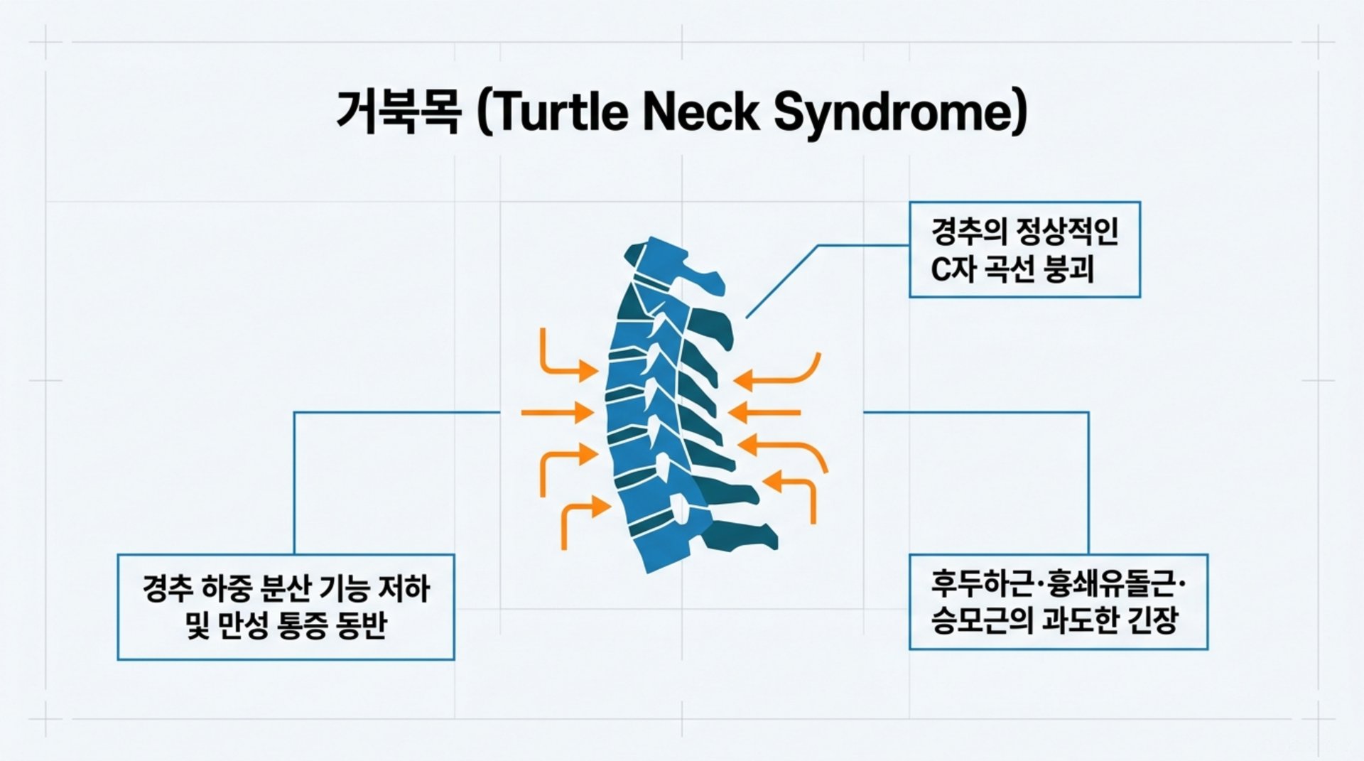표지 임상적 경추 변형: 거북목 증후군 올바른 경추 정렬 및 의학적 대처 지침
