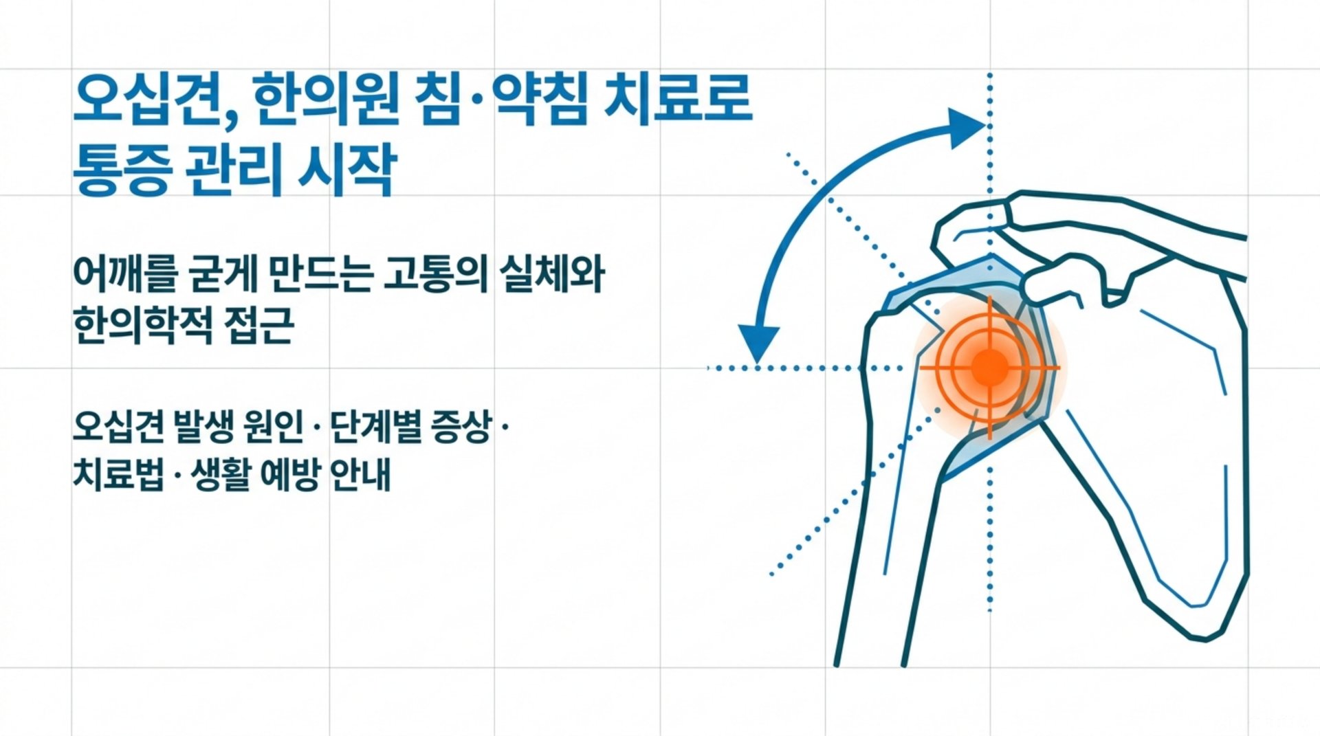 남가좌동 한의원 오십견, 한의원 침·약침 치료로 통증 관리 시작 안내 이미지