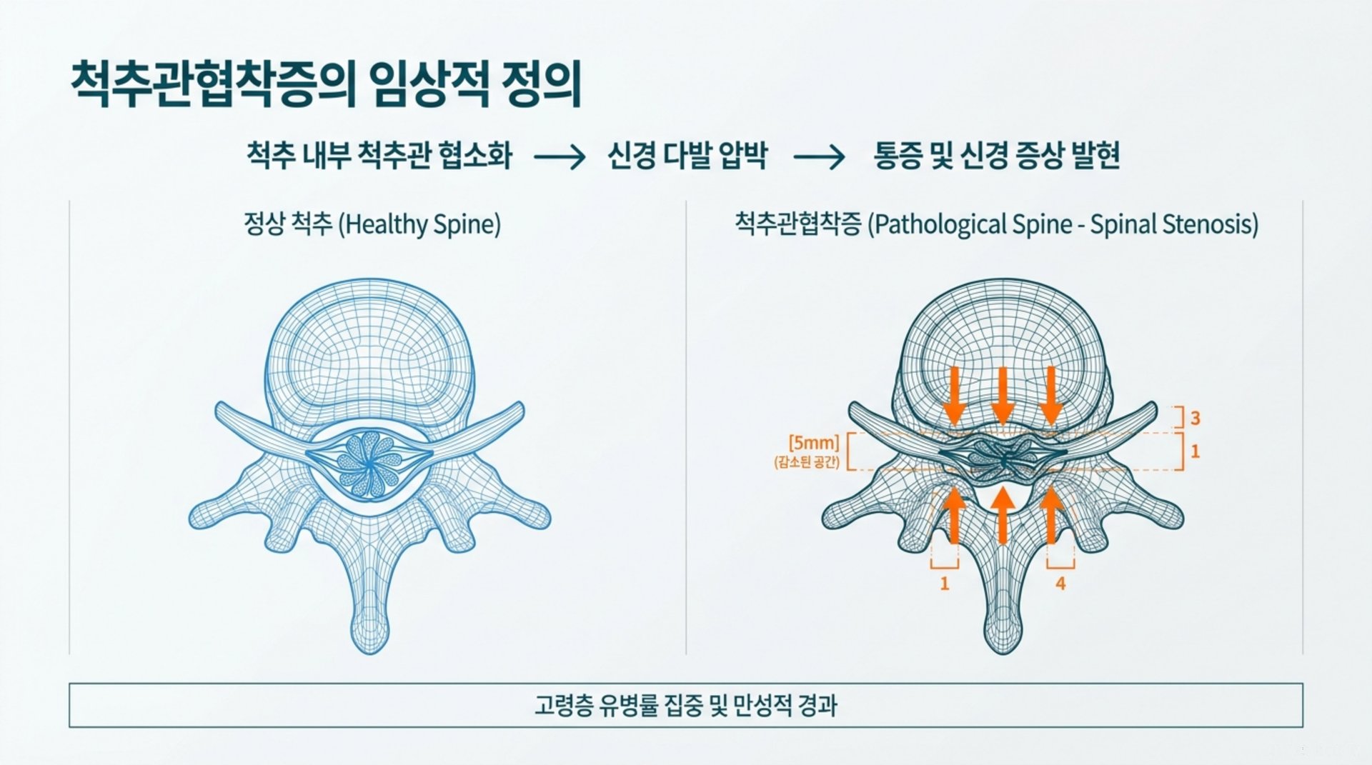 북가좌동 한의원 척추관협착증의 임상적 정의 안내 이미지