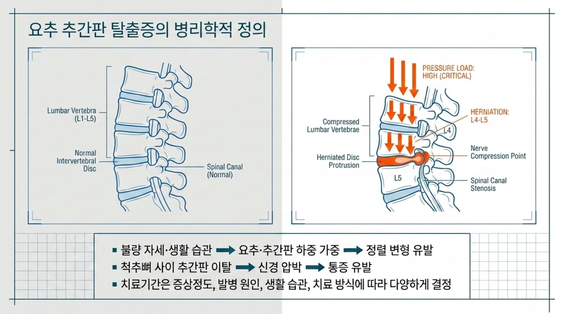 북가좌동 한의원 요추 추간판 탈출증의 병리학적 정의 안내 이미지