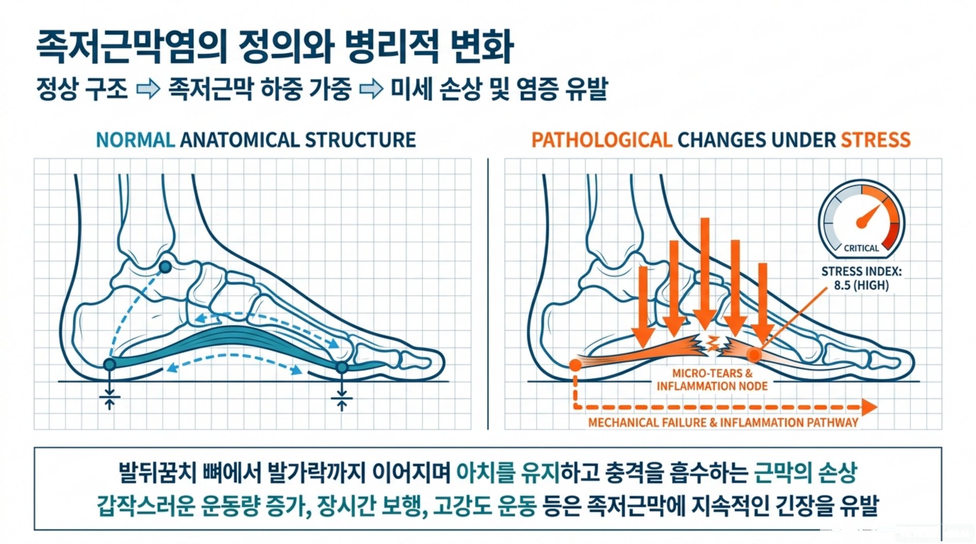 족저근막염을 유발하는 복합적 요인 분석