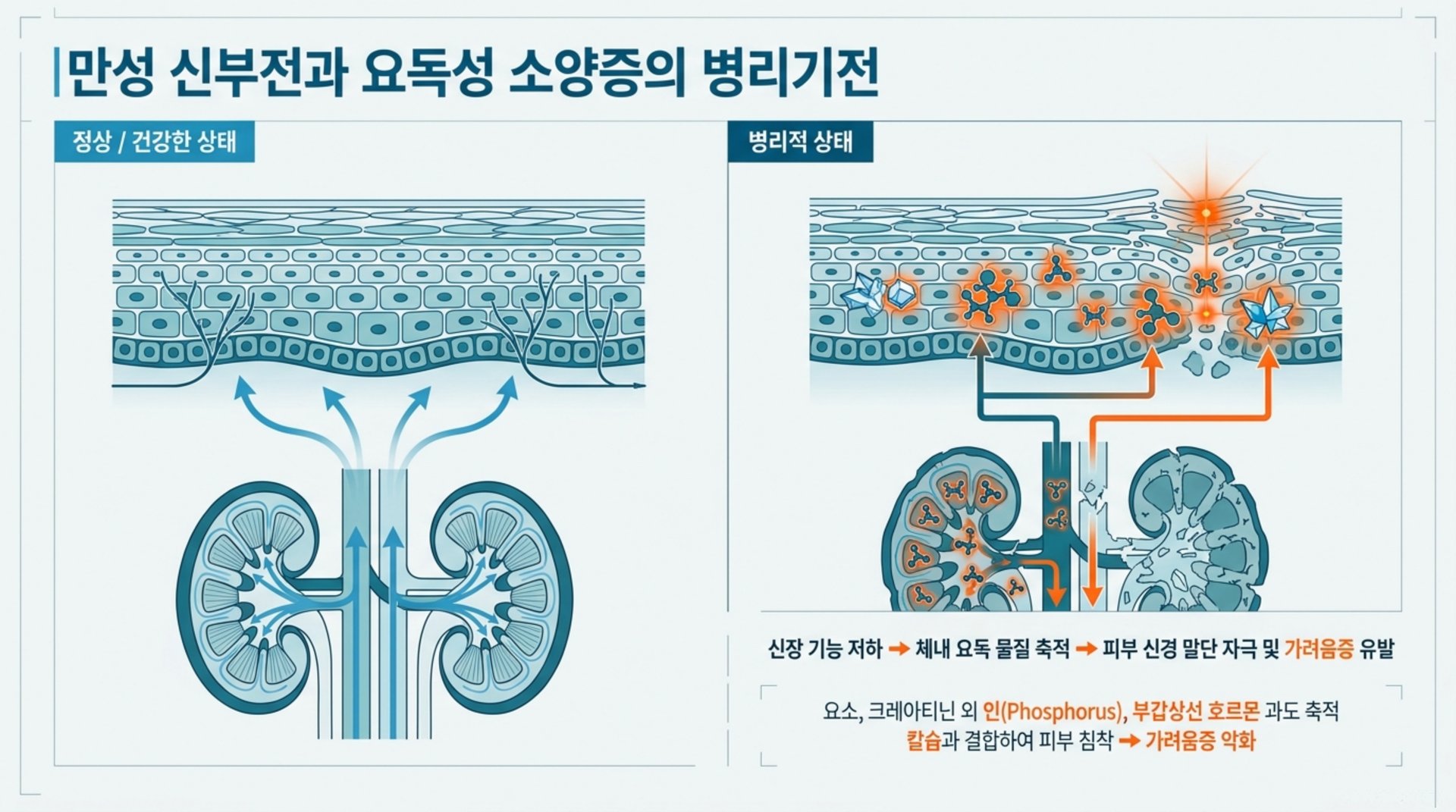북가좌동 한의원 만성 신부전과 요독성 소양증의 병리기전 안내 이미지