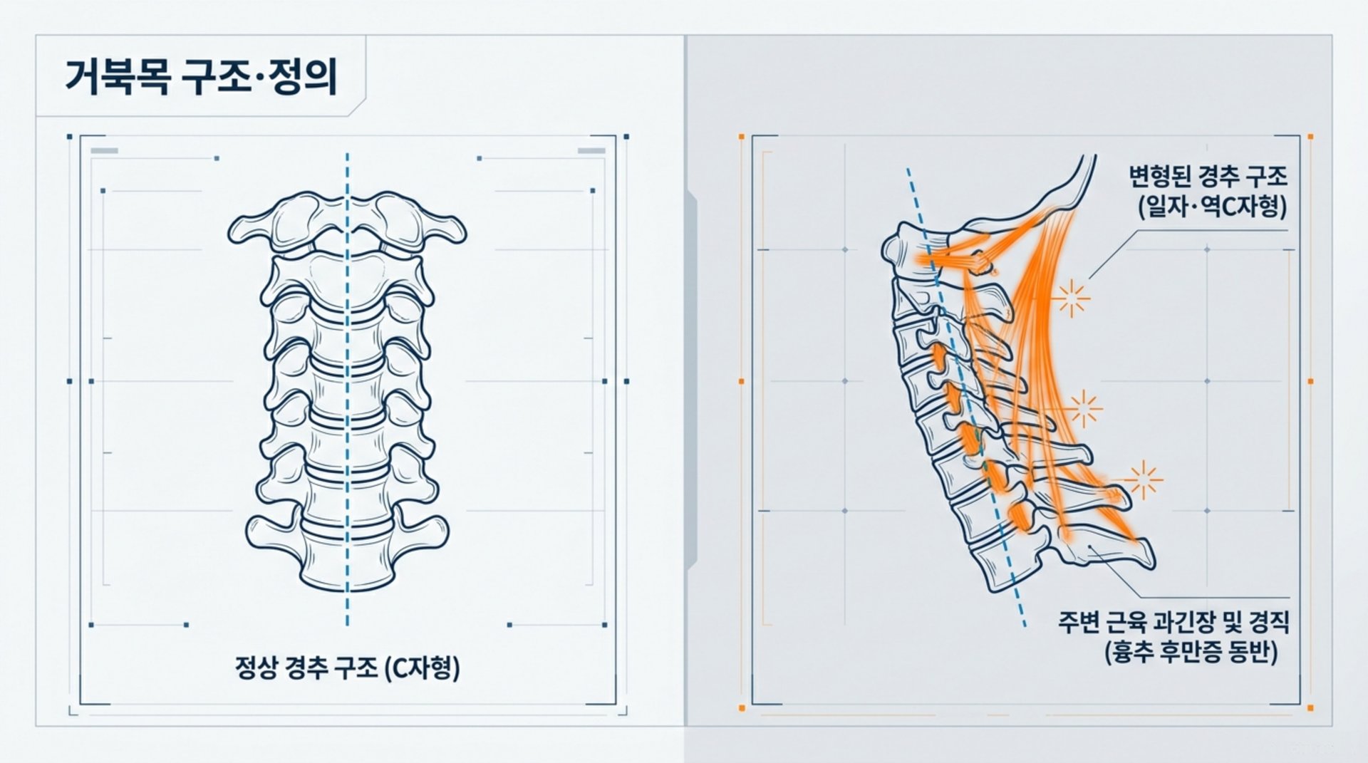 도입부 현대인과 경추 건강 이러한 상태가 지속되면 목을 지탱하는 후두하근, 흉쇄유돌근, 승모근 등 주변 근육들이 과도하게 긴장하고 경직되어 만성적인 통증