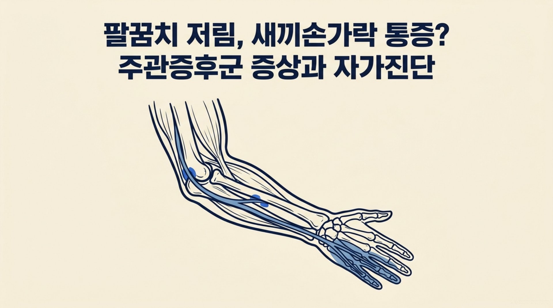 남가좌동 한의원 팔꿈치 저림, 새끼손가락 통증? 주관증후군 증상과 자가진단 안내 이미지