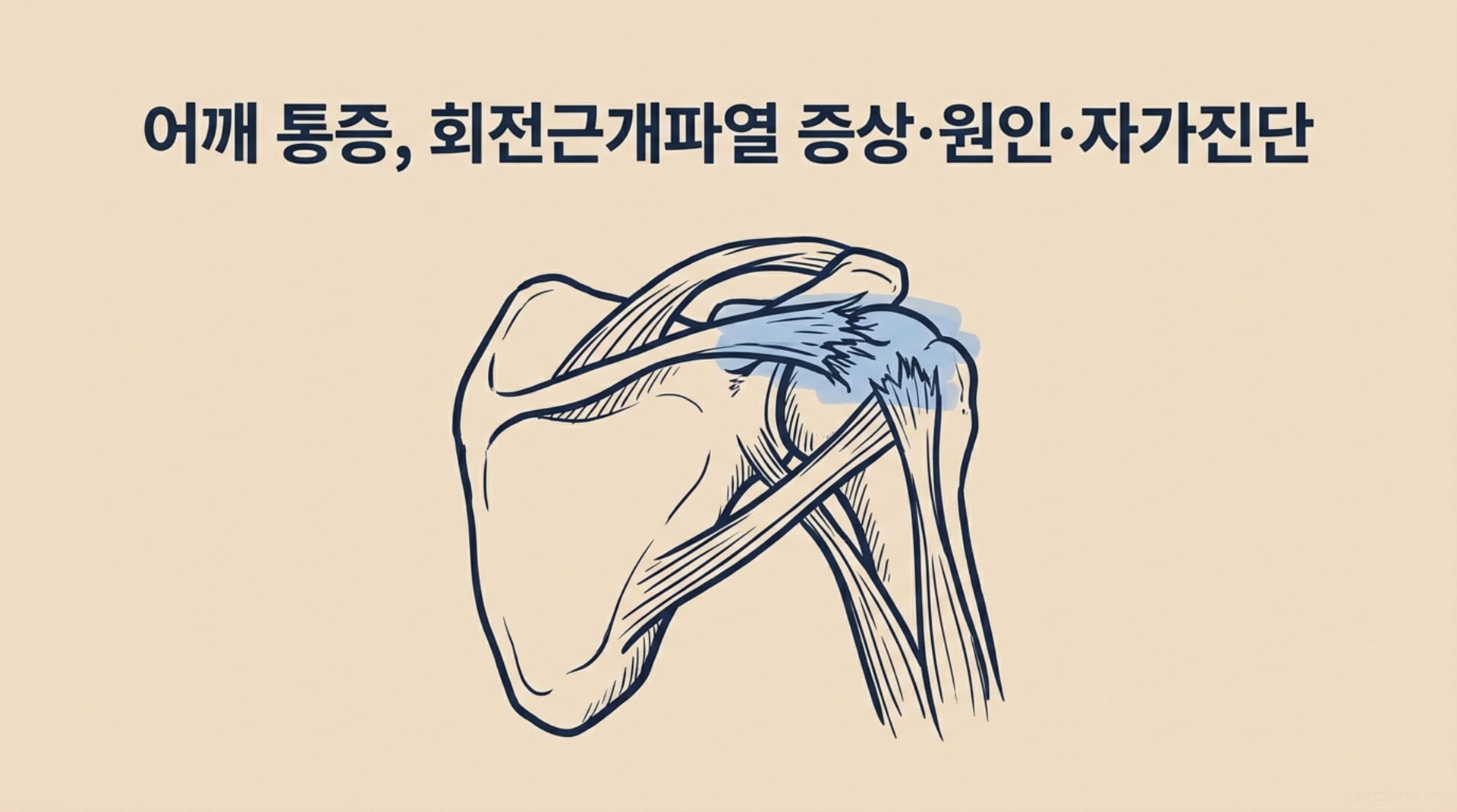 남가좌동 한의원 어깨 통증, 회전근개파열 증상·원인·자가진단 안내 이미지