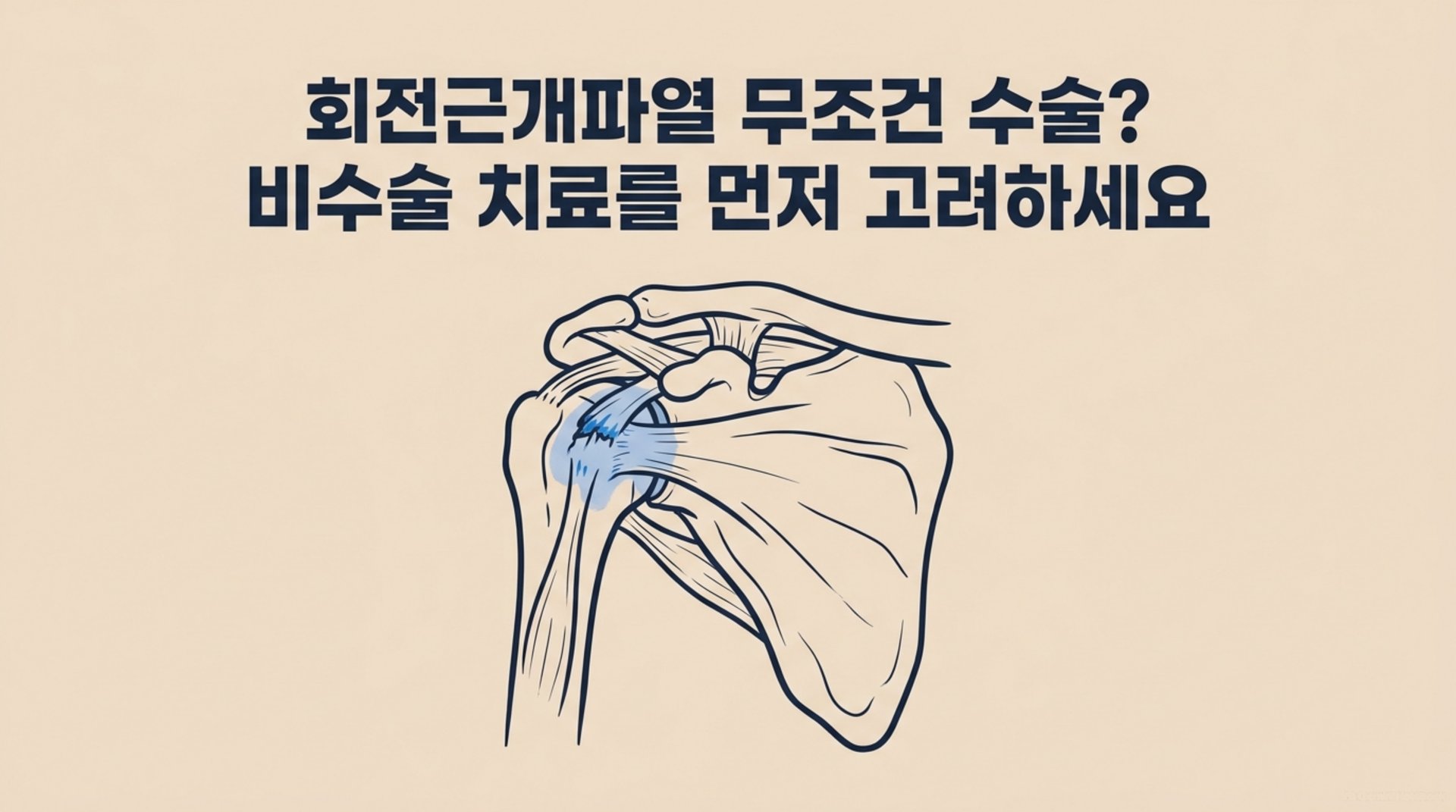남가좌동 한의원 회전근개파열 무조건 수술? 비수술 치료를 먼저 고려하세요 안내 이미지