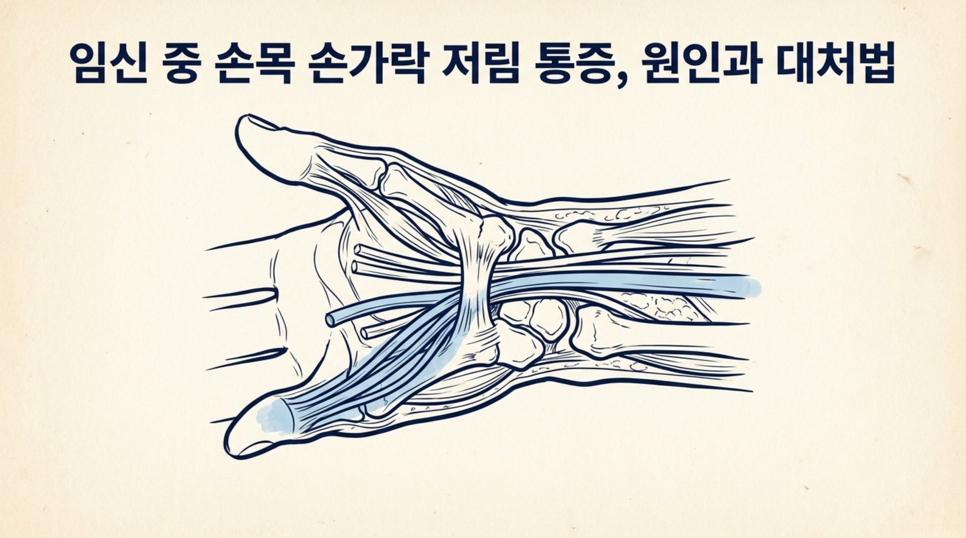 남가좌동 한의원 임신 중 손목 손가락 저림 통증, 원인과 대처법 안내 이미지