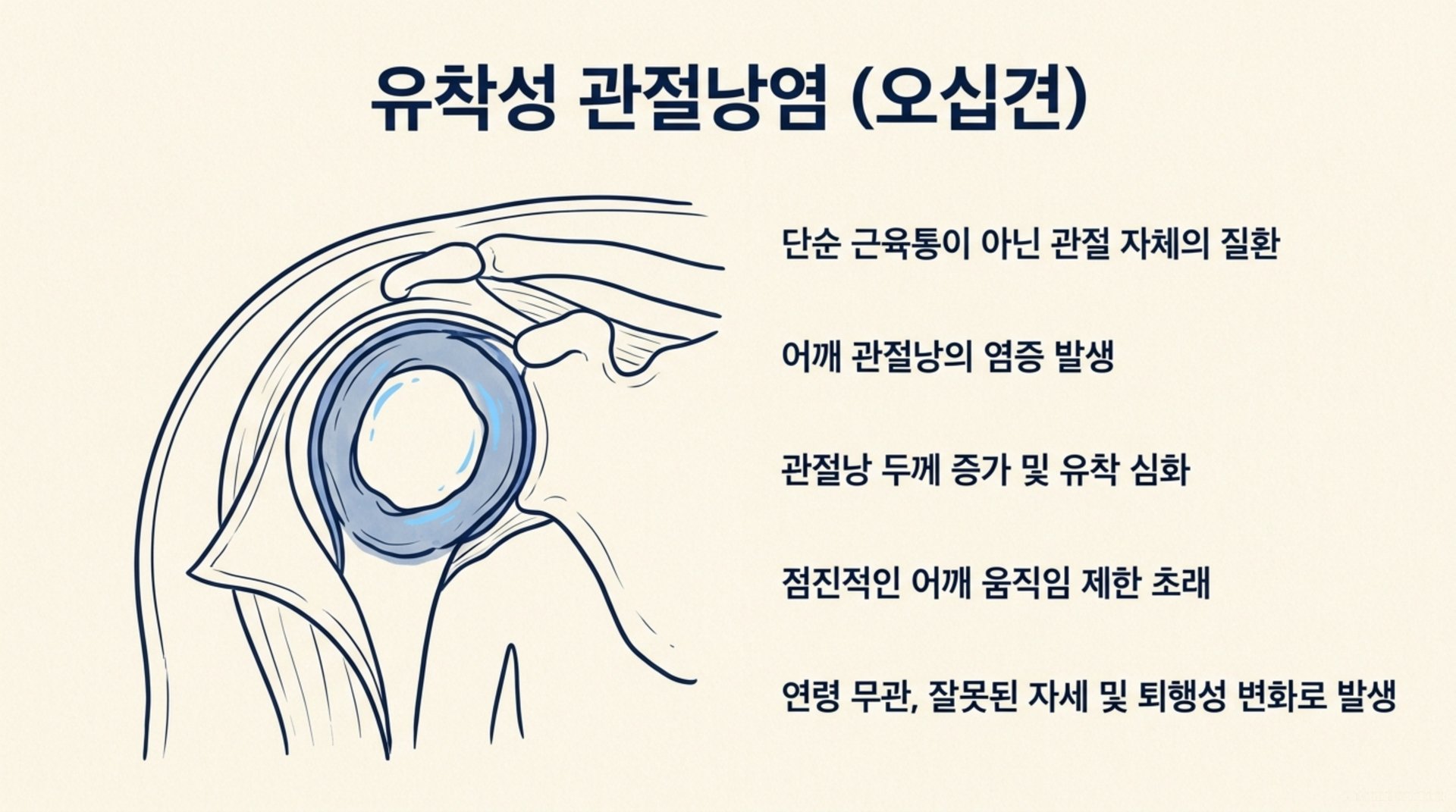북가좌동 한의원 유착성 관절낭염 (오십견) 안내 이미지