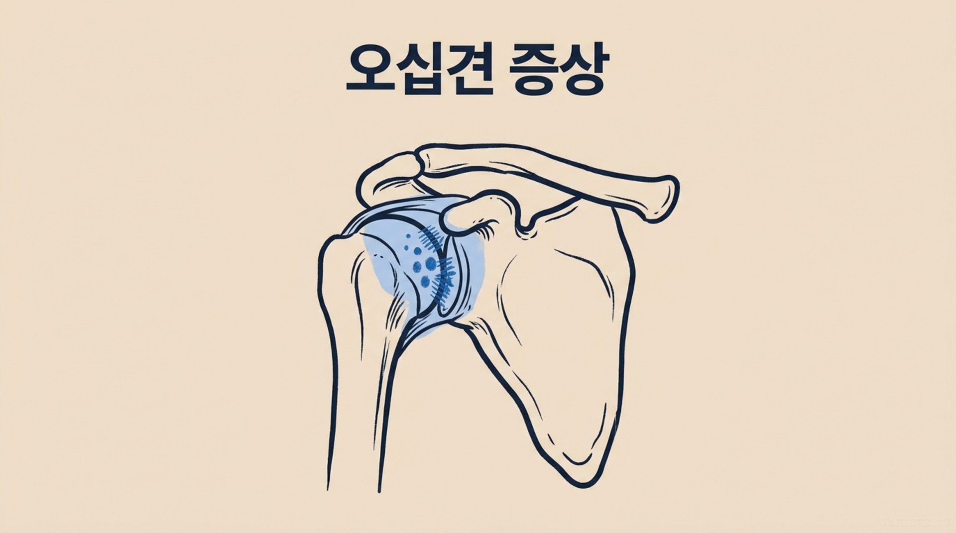 남가좌동 한의원 오십견 증상 안내 이미지