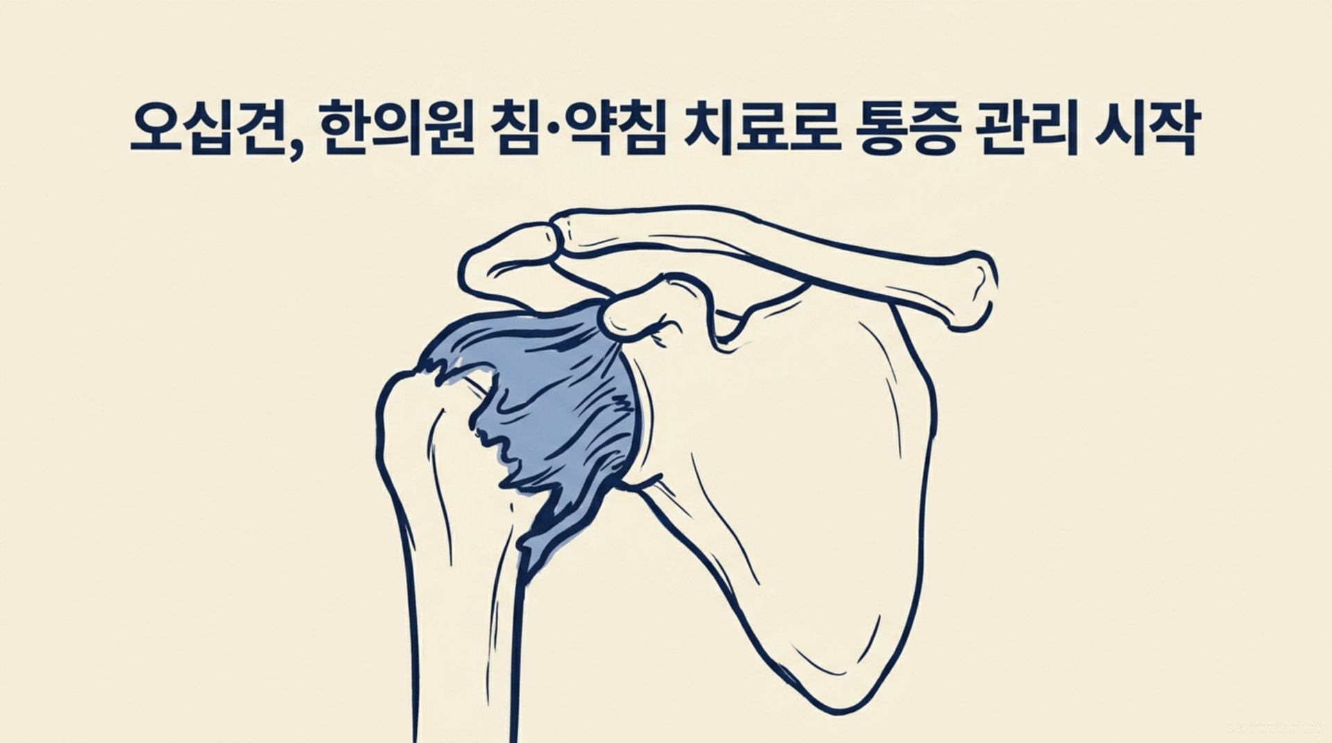 남가좌동 한의원 오십견, 한의원 침·약침 치료로 통증 관리 시작 안내 이미지