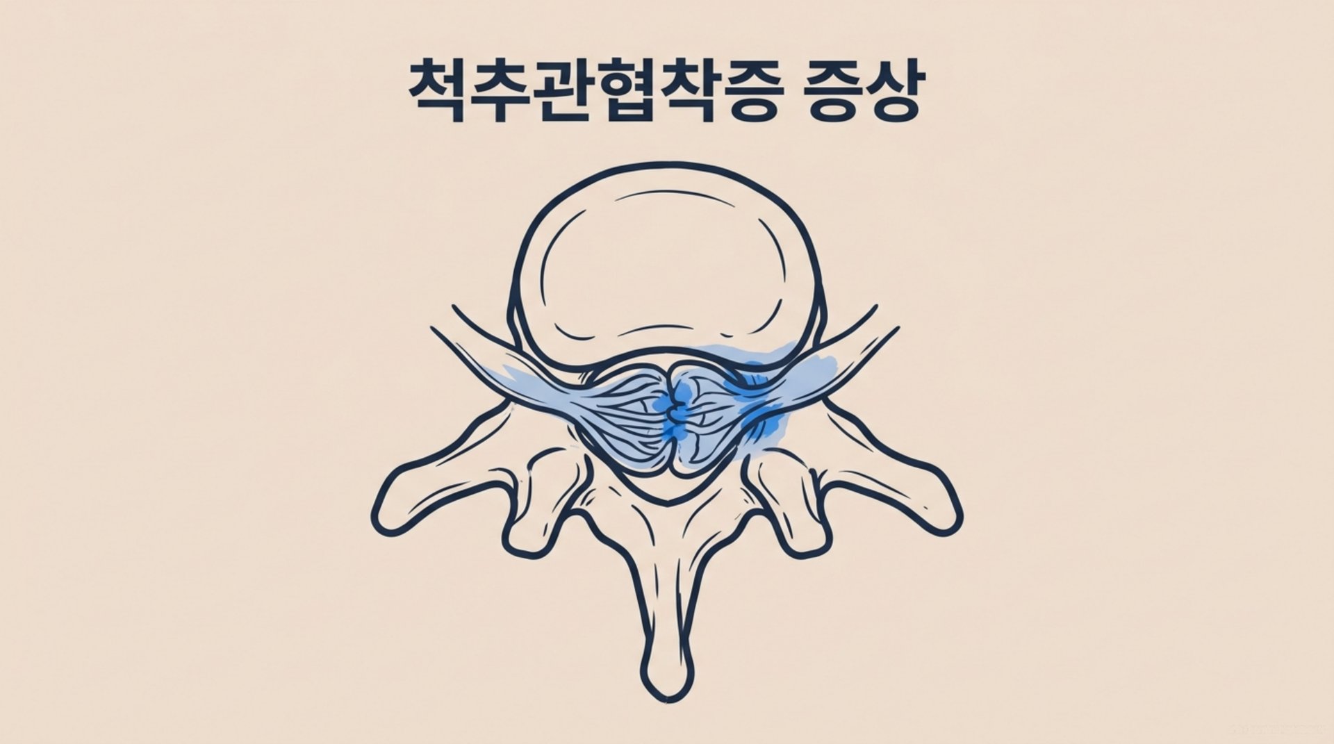 남가좌동 한의원 척추관협착증 증상 안내 이미지