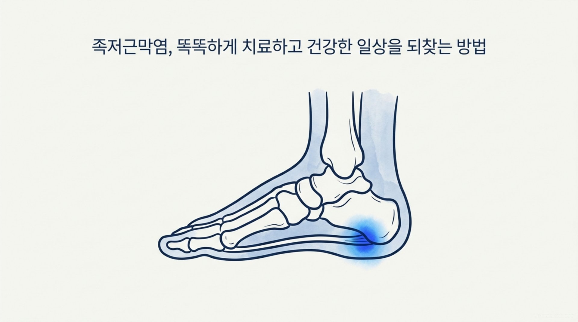 남가좌동 한의원 족저근막염, 똑똑하게 치료하고 건강한 일상을 되찾는 방법 안내 이미지