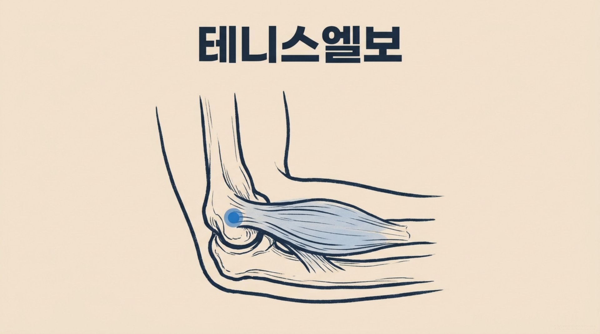 남가좌동 한의원 테니스엘보 안내 이미지