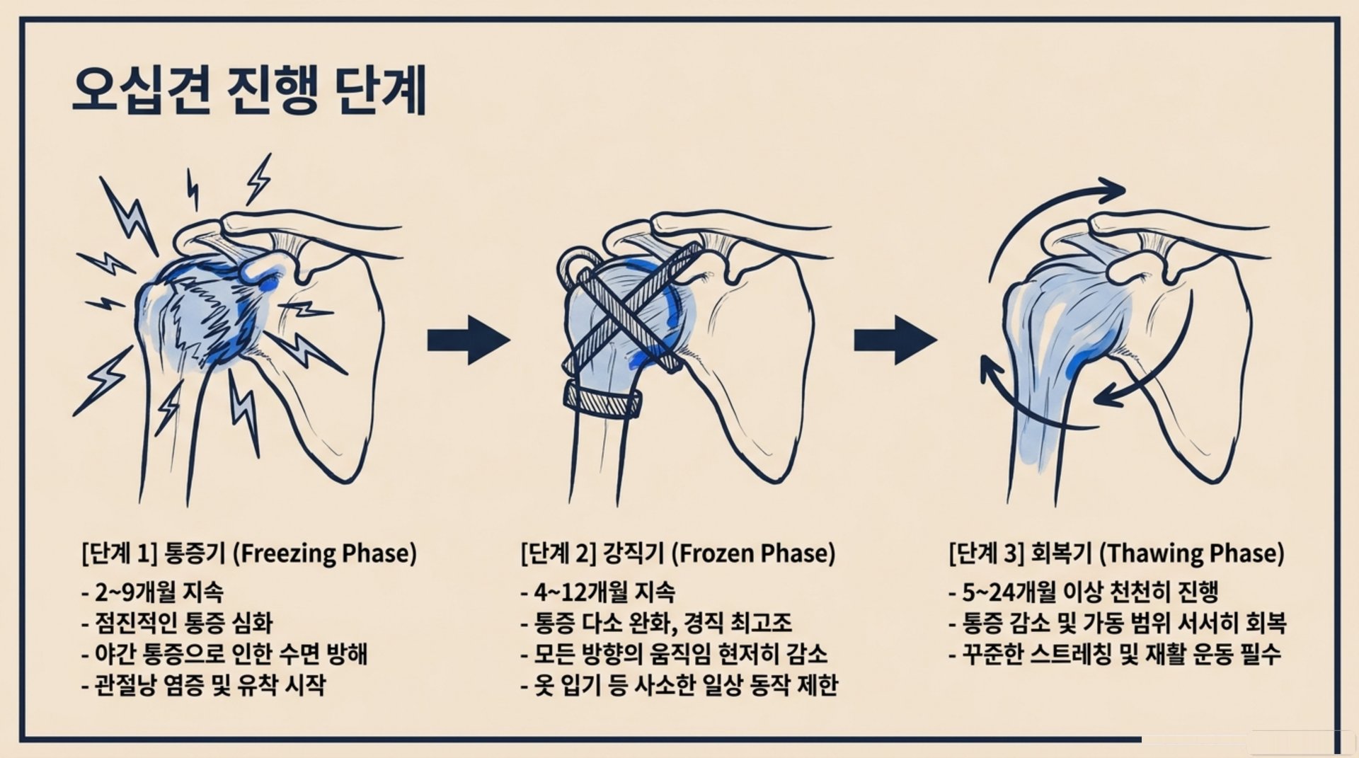 북가좌동 한의원 오십견 진행 단계 안내 이미지