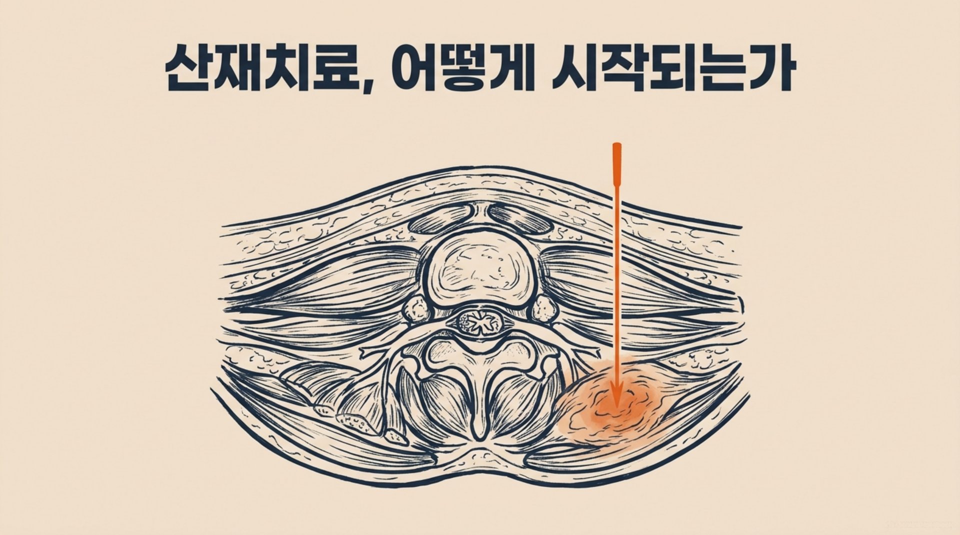 남가좌동 한의원 산재치료, 어떻게 시작되는가 안내 이미지